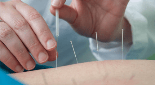Acupuncture: One Consumer’s Behind-the-Scenes View